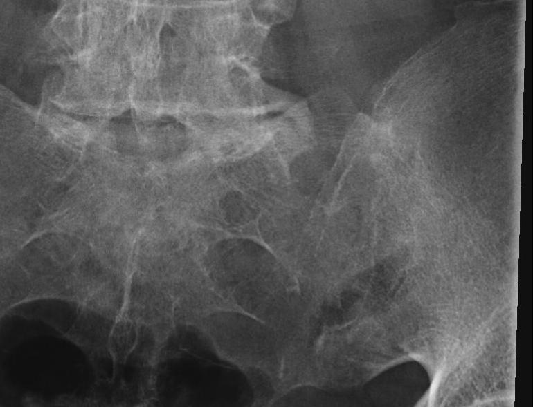 Sacroilitis Ankylosing Spondylitis